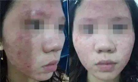 皮肤用药过度受损怎么保养皮肤用药过度受损的保养策略